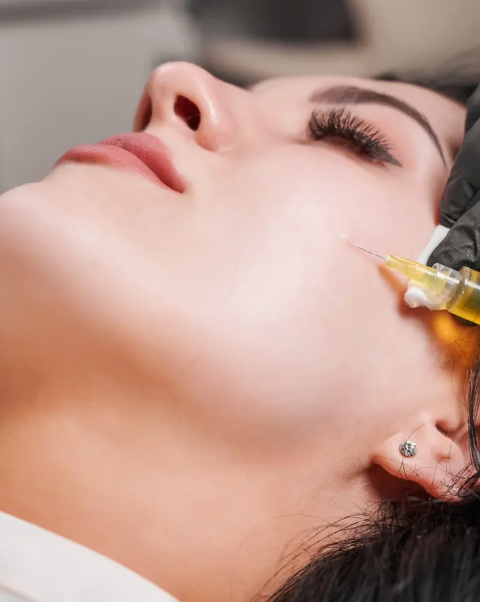 Dysport injection near the eyes to smooth crow's feet